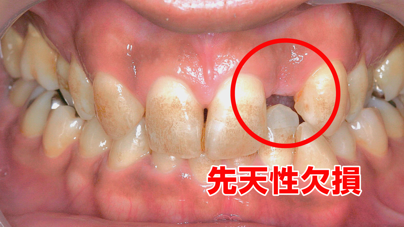 先天性欠損の上顎側切歯