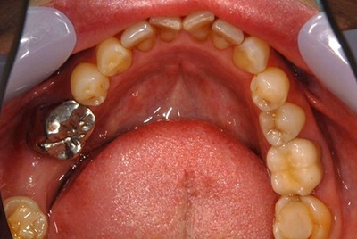 切らずに済むインプラント治療