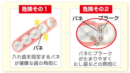 周りの歯にやさしい